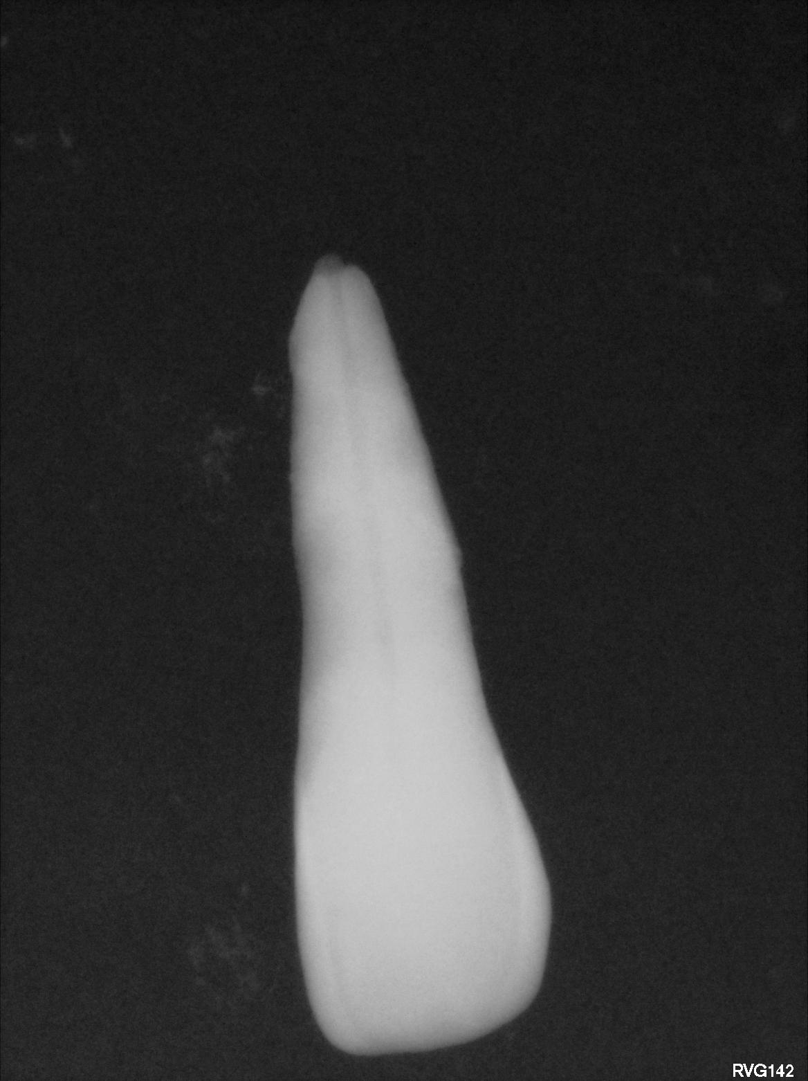 Upper Central Incisor