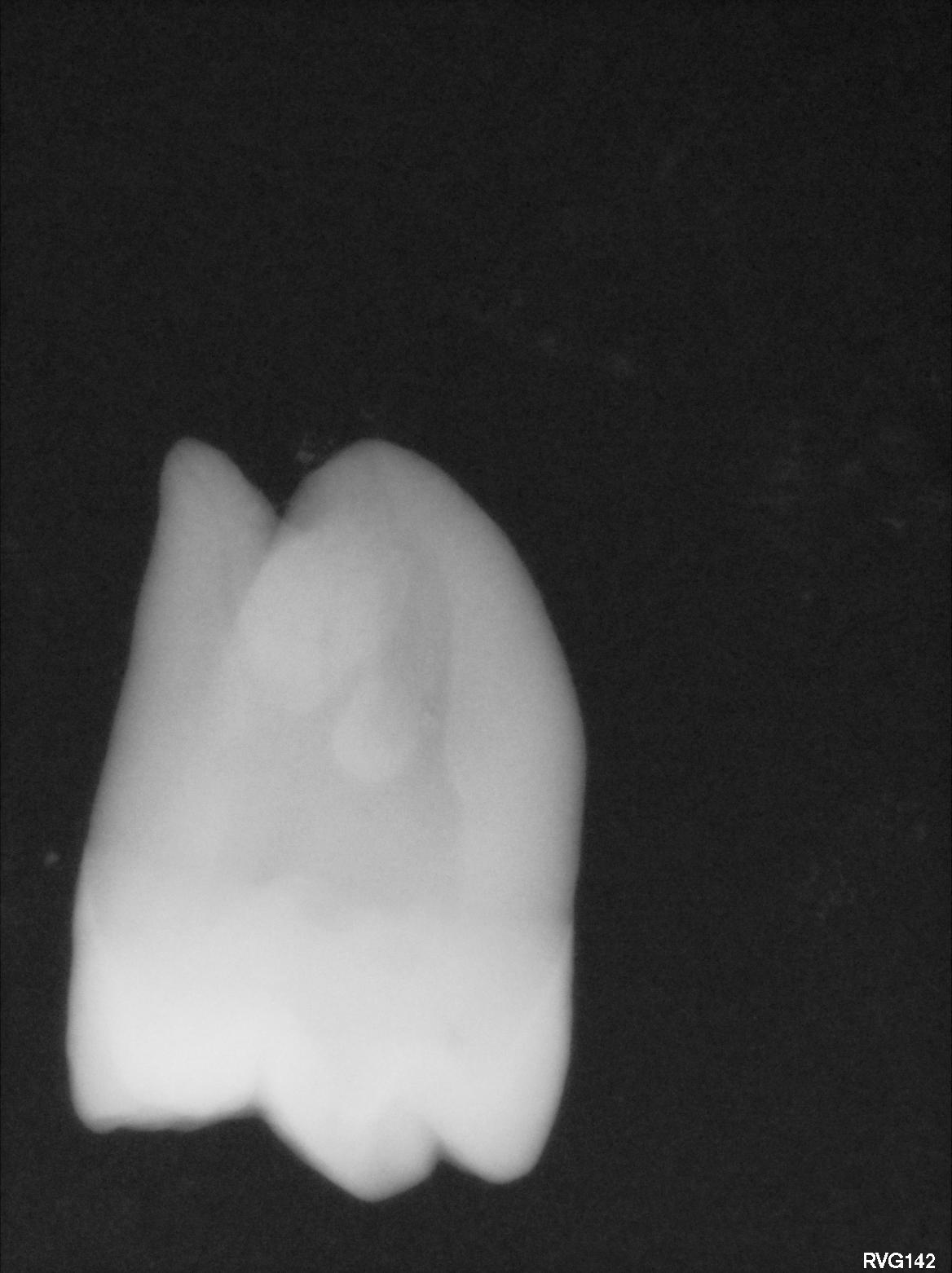 Mandibular Molar