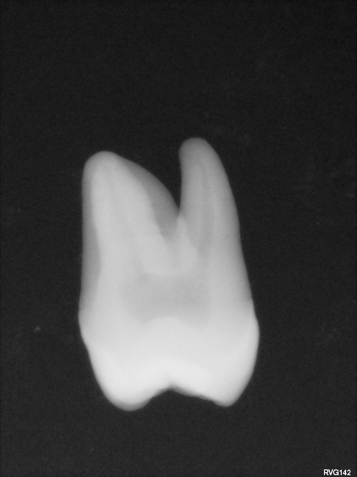 Premolar (Sectioned)